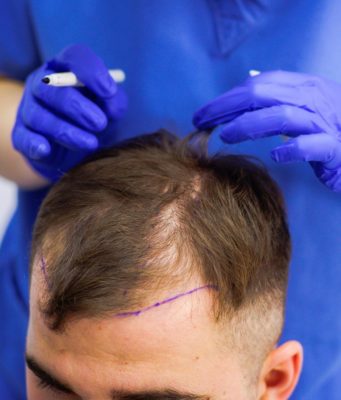 Пересадка волос: методы и особенности пересадки волос