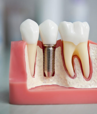 Установка импланта зуба — этапы и процедура установки