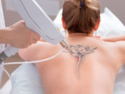 Лазерное удаление тату: особенности процедуры