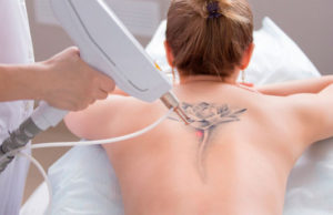 Лазерное удаление тату: особенности процедуры