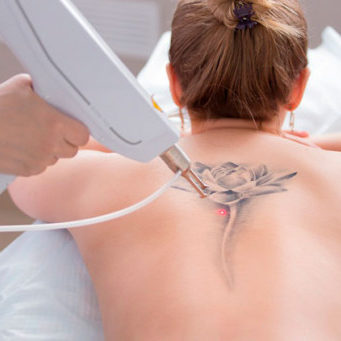 Лазерное удаление тату: особенности процедуры