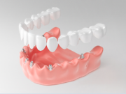 Чем хороши несъемные протезы?