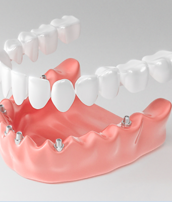 Чем хороши несъемные протезы?