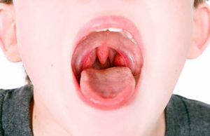 Аденоидит у детей: причины, признаки, диагностика