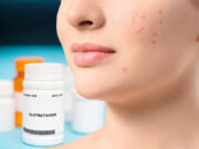 Isotretinoin: The Wonder Treatment for Acne