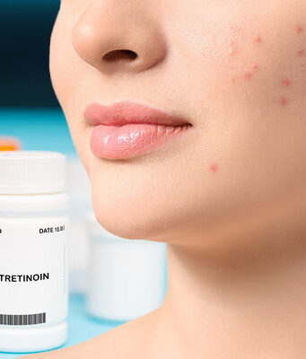 Isotretinoin: The Wonder Treatment for Acne
